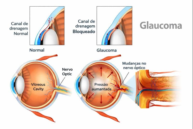 Glaucoma - Imagem 2