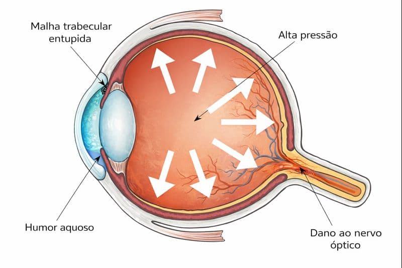 Glaucoma - Imagem 3